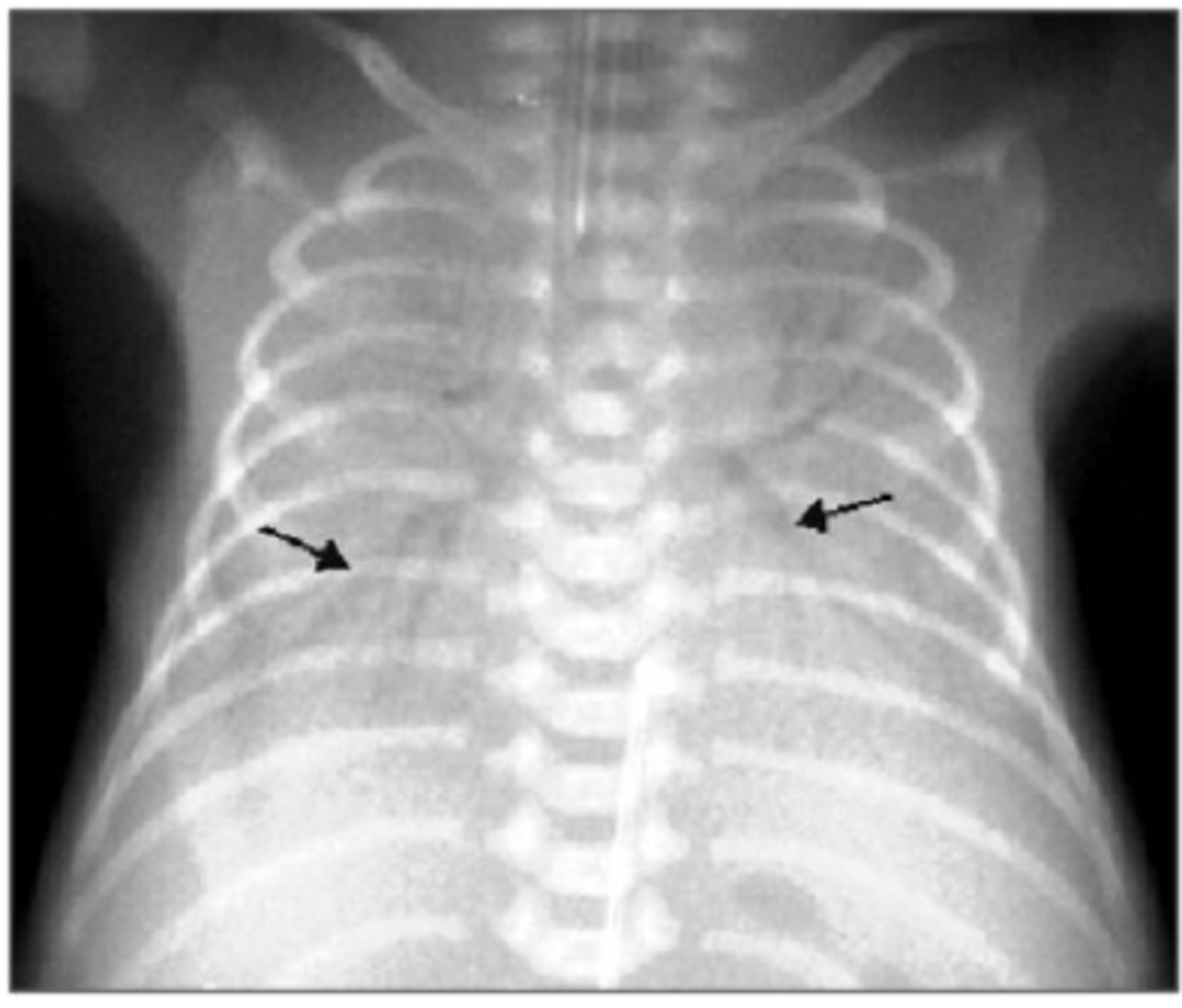 <p>d. Air bronchogram</p>
