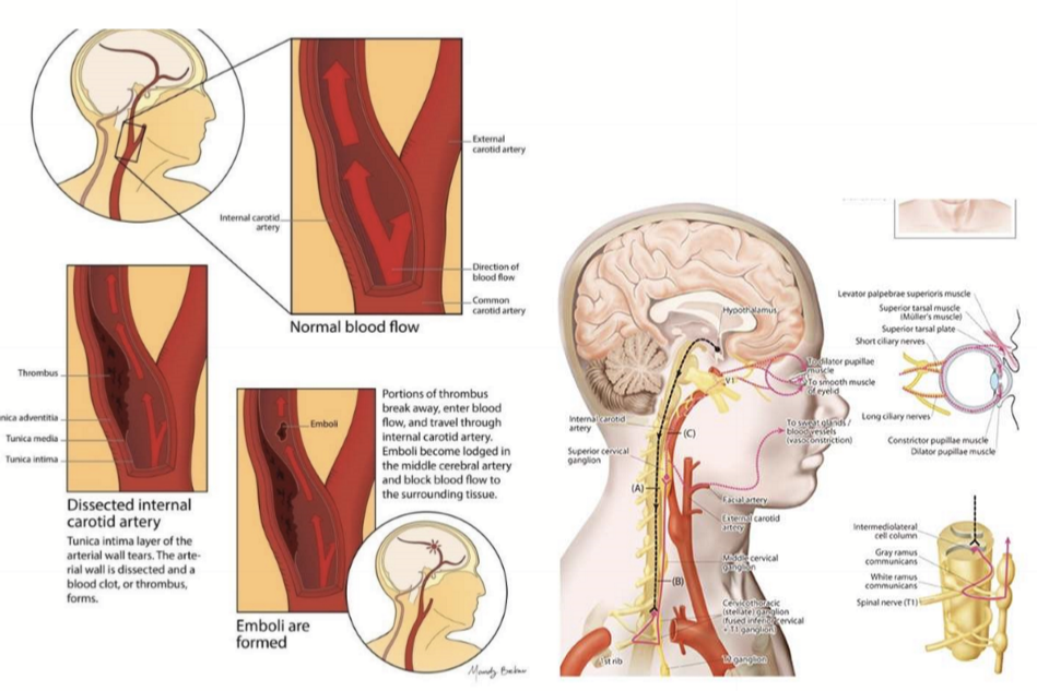 <ul><li><p>Ischemic Stroke (global or focal)</p></li><li><p>BRAO/CRAO</p></li><li><p>Horner’s Syndrome (sympathetic affected postganglion neuron) </p></li></ul><p></p>