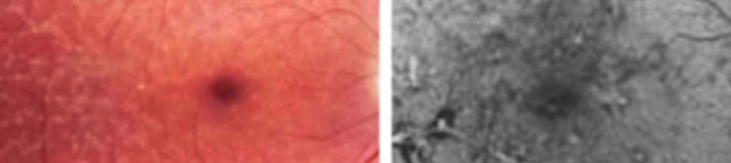 <p>an autosomal dominant* or autosomal recessive disease presenting in the 3rd-5th decade as coarse, net like lesions of the posterior pole involving the RPE. No treatment, but may fade with age and has good prognosis. ERG normal, EOG subnormal due to RPE involvement.</p>