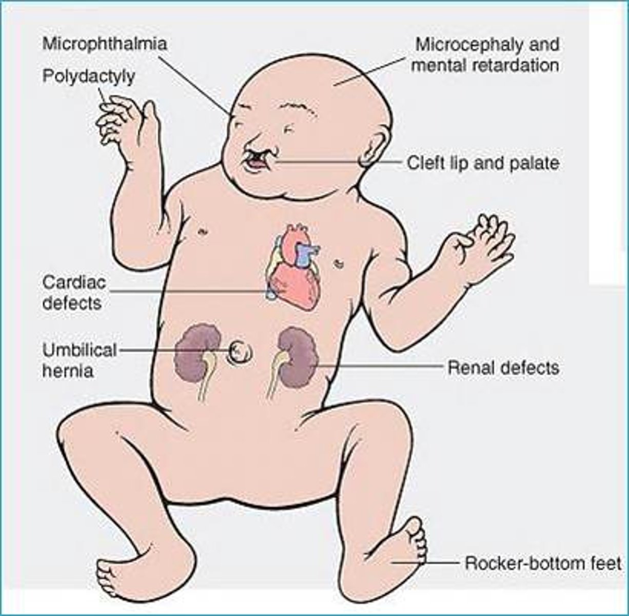<p>extra copy of chromosome 13</p><p>birth defecits. congenital heart defects, brain anomalies, spina bifida, severe eye defects, cleft lip and palate, polydactyly. many have midline facial deformities and cleft lip -> indicates holoprosencephaly (failure of brain to divide into 2 hemispheres.</p><p>Many die in first year. Others have profound ID and feeding difficulties which require nasogastric feeding</p>