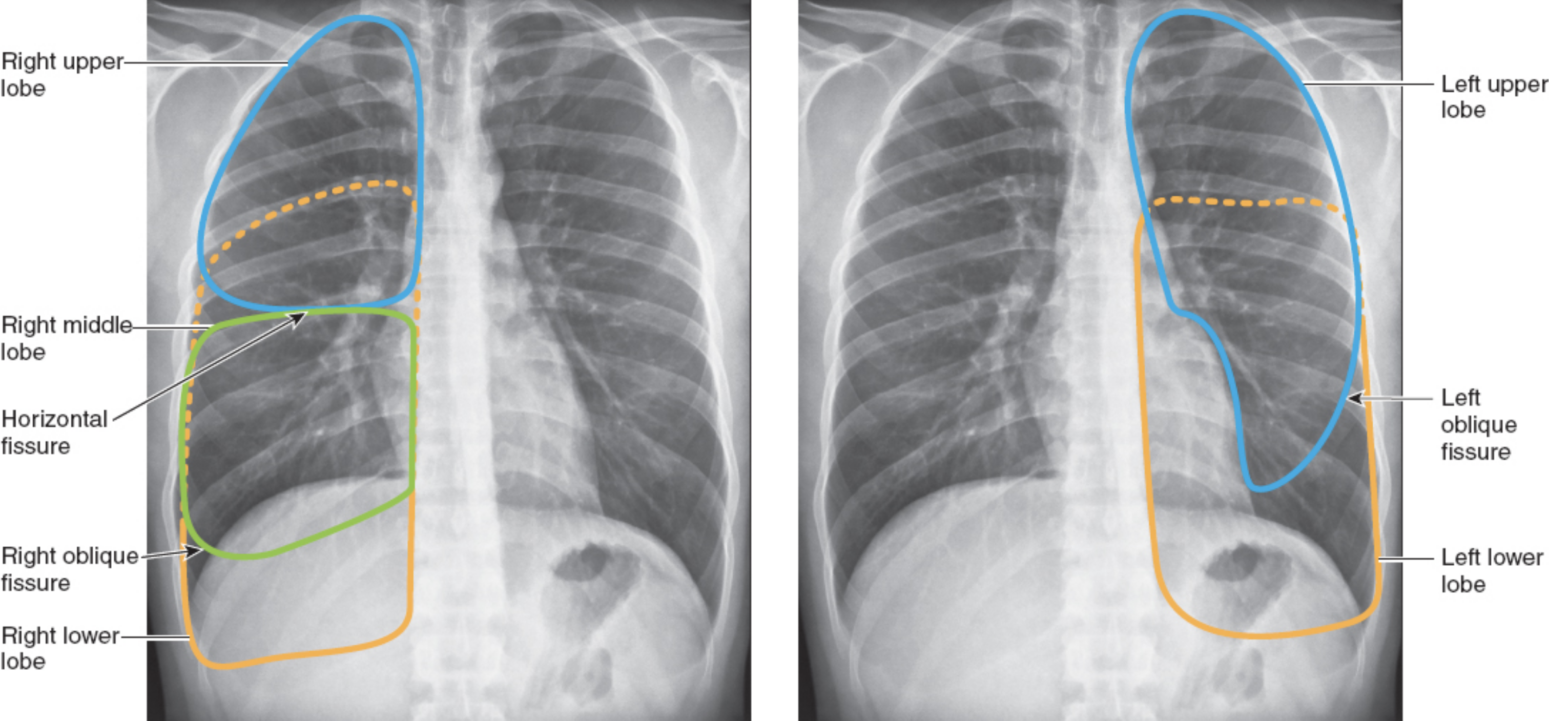 <p>The left lung has no middle lobe<br>The anterior chest contains mostly upper and middle lobe with little lower lobe<br>The posterior chest contains almost all lower lobe</p>