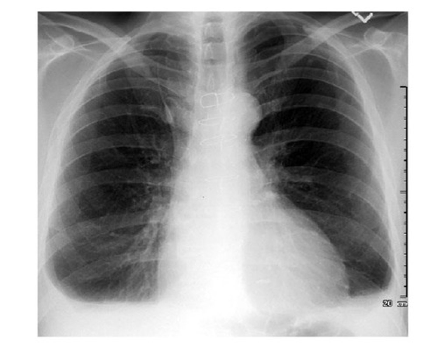<p>1) pleural effusion on the right is clear with the meniscus seen in the radio-opaque area —&gt; could perform thoracentesis to sample a fluid to give us some clues</p><p>2) blunting of the costophrenic angles as well; should usually be sharp as her left side; looks more like the image attached</p>