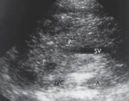 <p>A patient with gallstones presented to the ER and this was seen at the pancreas. What can be assumed?</p>