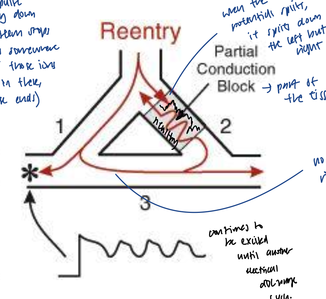 <ul><li><p>there is a partial conduction block, where part of the tissue is dead</p></li><li><p>when action potential travels down the branches of purkinje fiber, it continues to path 1, but not path fully 2 because of the partial blocked dead tissue</p></li><li><p>action potential from path 1 cannot get canceled out because of the partial dead tissue blocking the traveling in path 2</p></li><li><p>thus, action potential travels the other side of the dead tissue and reexcite the cells that are beginning to repolarized</p><ul><li><p>this leads to early afterdepolarizations</p></li><li><p>this is called a reentry loop because cells from SA node are depolarized by the same SA node pace without a new pace</p></li></ul></li></ul><p></p>