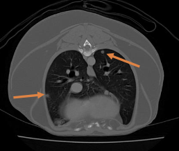 <p>-3 view chest rads</p><p>- +/- abdominal imaging (consider with subtype, high grade pelvic limb STS)</p><p>- +/- advanced imaging (CT or MRI) for tx planning</p>