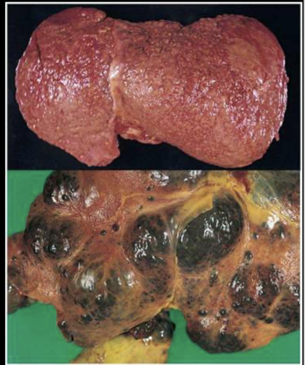 <p>1.Irreversible inflammatory disease</p><p>2. decrease hepatic function due to fibrosis</p><p>Alcoholic</p><p>-- The oxidation of alcohol damages hepatocytes</p><p>Biliary (bile canaliculi)</p><p>-- Cirrhosis begins in the bile canaliculi and ducts</p><p>-- Primary biliary cholangitis (PBC-autoimmune cirrhosis)</p><p>-- Secondary biliary cirrhosis (obstruction)</p><p>Postnecrotic</p><p>-- Consequence of chronic disease (hepatitis B and C, PBC)</p>