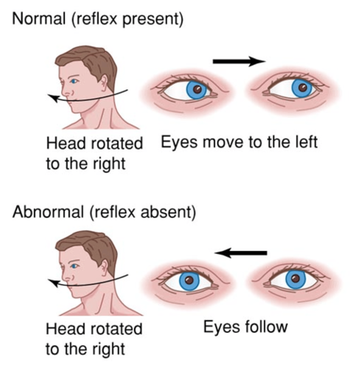 <p>intact – eyes turn to keep looking at the same spot</p><p>lesion – eyes move with head</p>
