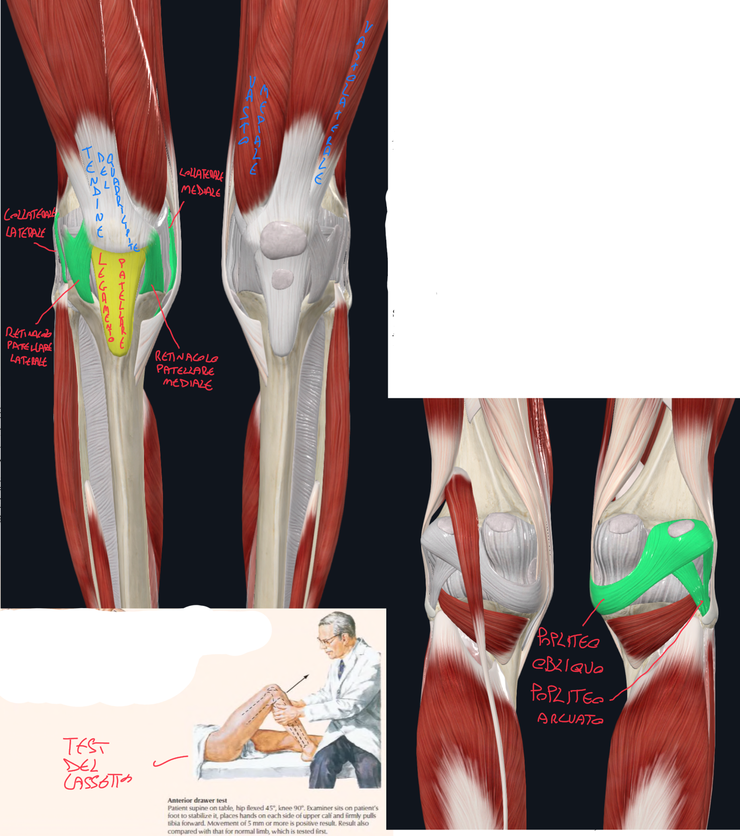 <p>LEGAMENTO PATELLARE:</p><ul><li><p>Prolungamento del tendine del muscolo retto del quadricipite femorale</p></li><li><p>Origina dall’apice della patella e si inserisce sulla tuberosità tibiale.</p></li></ul><p>RETINACOLI PATELLARI:</p><ul><li><p>Ai lati del tendine del quadricipite e del legamento patellare,</p></li><li><p>Come espansioni del vasto laterale e mediale si inseriscono ai lati della tuberosità tibiale</p></li></ul><p>CLINICA:</p><ul><li><p>La forza di trazione sviluppata dal quadricipite tenderebbe a spostare la patella lateralmente (lussazione laterale)</p></li><li><p>In questo, il retinacolo e vasto mediale forniscono un rinforzo maggiore rispetto quello laterale, bilanciando questa tendenza allo spostamento laterale</p></li></ul><p>LEGAMENTI POSTERIORI DEL GINOCCHIO:</p><ul><li><p>Legamento Popliteo Obliquo → espansione del muscolo semimebranoso (che si inserisce sotto il condilo mediale della tibia)</p></li><li><p>Legamento Popliteo Arcuato → esteso tra testa della fibula e superficie posteriore capsula fibrosa del ginocchio</p></li></ul><p>LEGAMENTI COLLATERALI:</p><ul><li><p>Legamento collaterale mediale (tibiale) → appiattito, tra epicondilo mediale del femore e superficie mediale della tibia → aderisce alla capsula fibrosa e le sue fibre si fondono con il menisco mediale</p></li><li><p>Legamento collaterale laterale (fibulare) → cordoniforme, tra epicondilo laterale del femore all’apice della fibula → non aderisce alla capsula, infatti è separata da essa dal tendine del muscolo popliteo</p></li><li><p>Funzione → stabilizzano l’articolazione in estensione (tesi in estensione), limitano la rotazione del femore sulla tibia.</p></li></ul><p>TEST DEL GINOCCHIO:</p><ul><li><p>Le strutture più lesionate sono il crociato anteriore, collaterale e menisco mediale.</p></li><li><p>Test del Cassetto → a ginocchio flesso, il medico sposta in avanti la tibia rispetto il femore. Il legamento crociato anteriore dovrebbe impedire questo movimento che se avviene il test è positivo è indica lesione del crociato anteriore</p></li><li><p>Test dei Menischi → forze di pressione e rotazione evocano dolore selettivo.</p></li></ul><p></p>