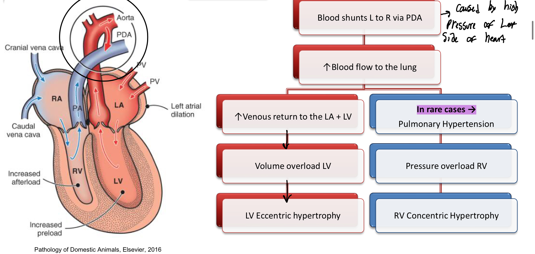<ol><li><p>Blood shunts from L to R via the PDA</p></li><li><p><span style="color: rgb(0, 143, 255);">Inc</span> of blood flow to the lungs</p><ol><li><p><span style="color: rgb(0, 106, 255);">Inc</span> of <span style="color: blue;">Venous</span> blood to the LA+LV</p><ol><li><p>Volume overload of LV</p><ol><li><p><strong><u>LV hypertrophy</u></strong></p></li></ol></li></ol></li><li><p>Rare CASES: Pulmonary Hypertension (Inc B.P of arteries in the lungs)</p><ol><li><p>Pressure overload of RV</p><ol><li><p>RV COncentric hypertrophy</p></li></ol></li></ol></li></ol></li></ol><p></p>