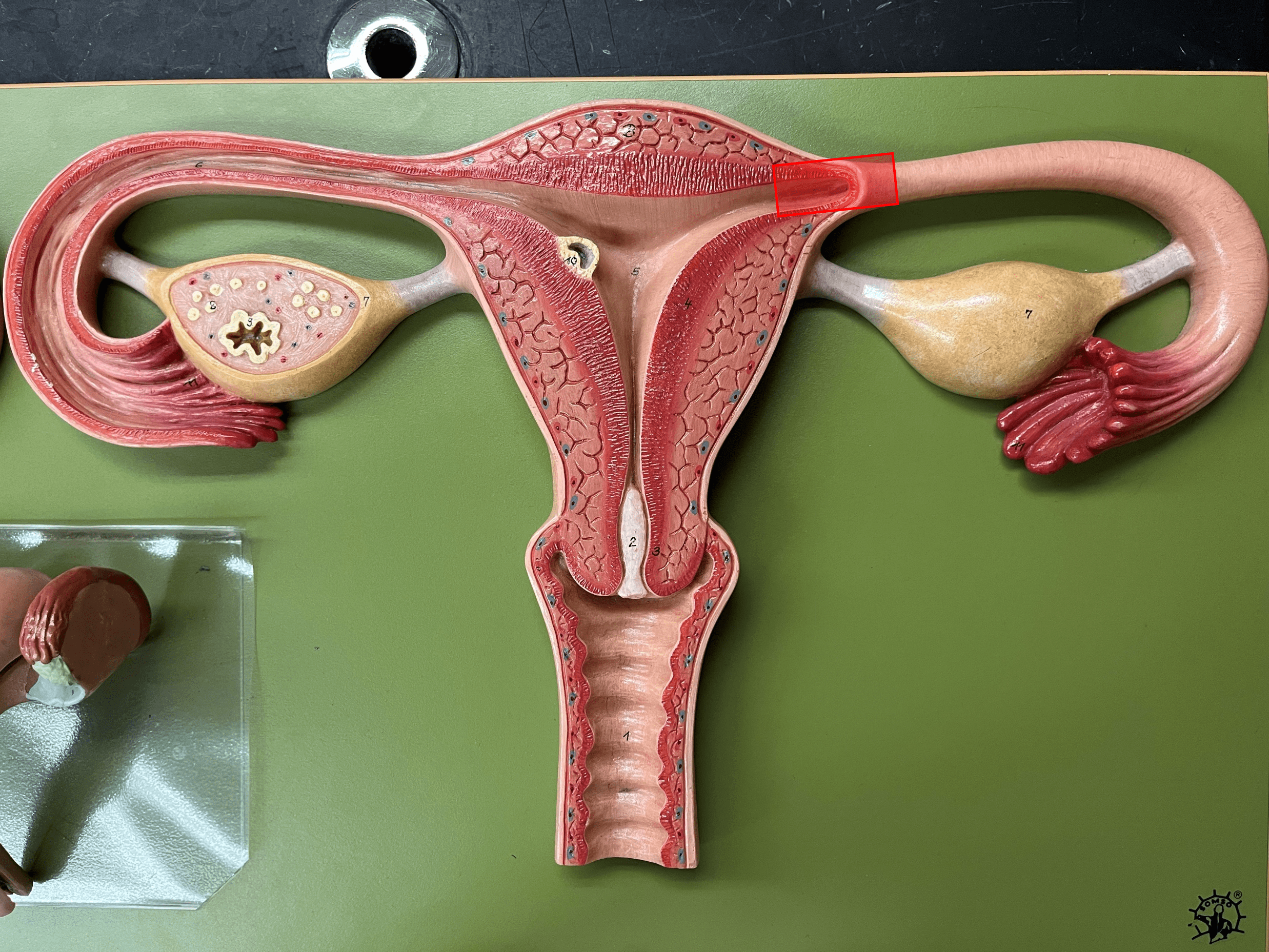 • A region of the uterine tube.

• The superior end of the uterine tube opening into the uterus.