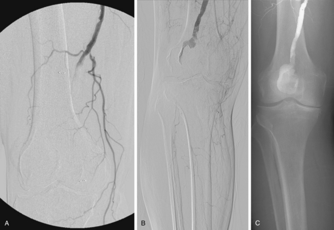 <p>catheter to view blood vessels </p>