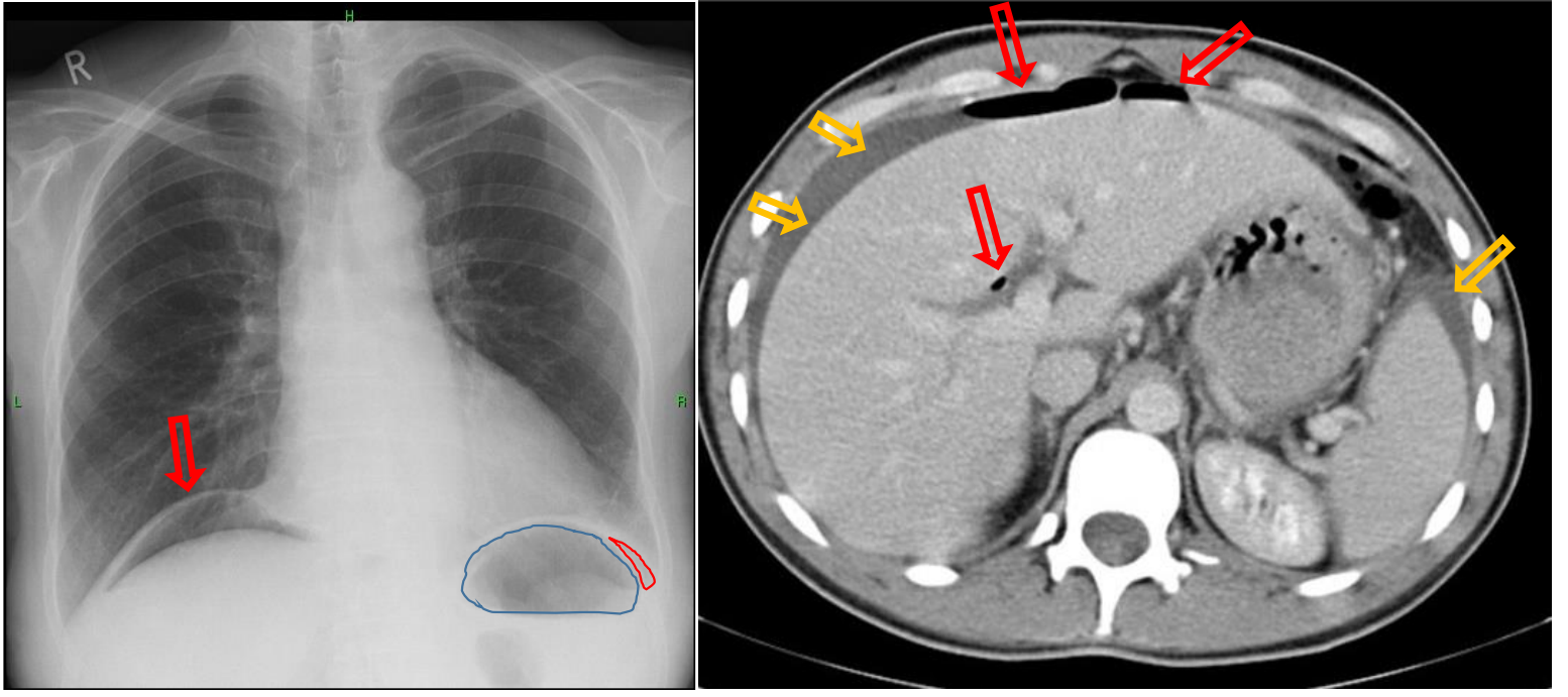 <p>Patient history: sudden and severe upper abdominal pain, vomiting</p><p>Modality: left – PA chest radiograph, frontal projection (upright position); right – contrast-enhanced CT, axial view</p><p>Region: chest, upper abdomen</p><p>Radiologic sign: Crescents of radiolucency under the hemidiaphragms (red arrows and outline) on the radiograph, free air accumulation at the convexity of the liver and at the liver hilum with density of -1000 HU (red arrows), perihepatic and perisplenic free fluid with density of 0 HU (yellow arrows) on CT.</p><p>Diagnosis: free abdominal air after ulcer perforation</p>