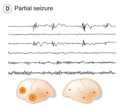 <p>Only activity in the 1st and 3rd lines of the recording is changed with synchronous abnormal discharges in the left frontal and temporal regions.</p><p></p><p>The effects of a partial (focal) seizure depend upon the brain region affected, these are often due to lesions in the brain and are more common with age.</p>