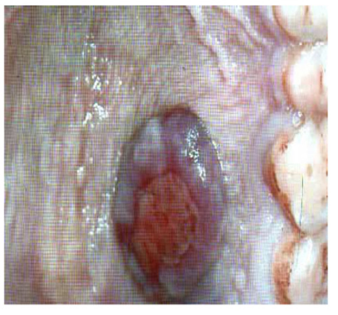 <p>malignant tumor of the blood vessels associated with AIDS - what am i?</p>