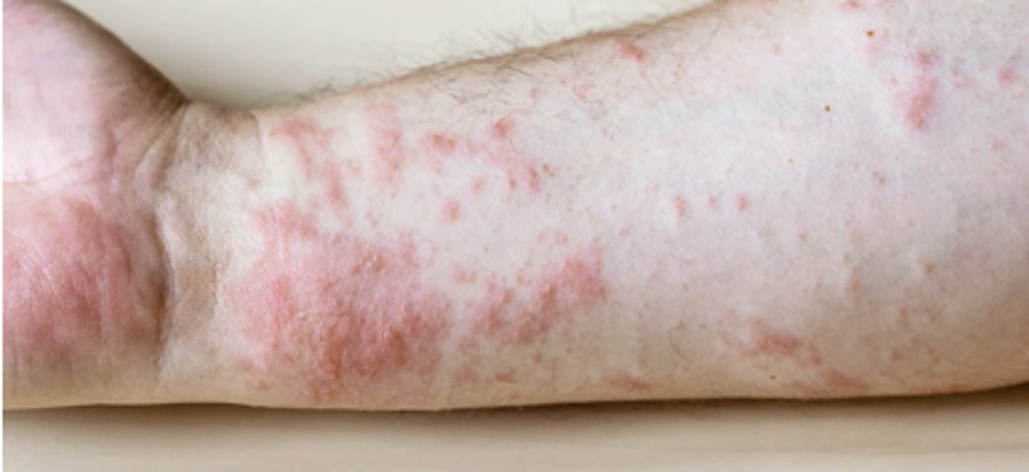 <p>•Appear as blotches, welts, or blisters; they can be red, itchy, scaly, or dry</p><p>•Many possible causes that aren't due to an underlying disease (chemicals, animals, scratchy clothes, sun exposure, medications, etc.)</p>