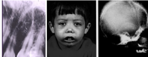 <p><span style="background-color: transparent; font-family: "Times New Roman", serif;">Thalassemia Major</span></p><p><span style="background-color: transparent; font-family: "Times New Roman", serif;">*Manifestations at ~1 yr</span></p><p><span style="background-color: transparent; font-family: "Times New Roman", serif;">*Hemolytic anemia</span></p><p><span style="background-color: transparent; font-family: "Times New Roman", serif;">*<strong>Increased hematopoiesis with bone marrow hyperplasia </strong></span></p><p><span style="background-color: transparent; font-family: "Times New Roman", serif;"><strong>and enlarged marrow spaces</strong></span></p><p><span style="background-color: transparent; font-family: "Times New Roman", serif;">*”<strong>Hair-on-end” </strong>appearance on skull xray</span></p><p><span style="background-color: transparent; font-family: "Times New Roman", serif;">*Enlargement of liver & spleen, lymphadenopathy</span></p><p><span style="background-color: transparent; font-family: "Times New Roman", serif;"><strong>*Enlargement of maxilla and mandible (“chipmunk faces”)</strong></span></p><p><span style="background-color: transparent; font-family: "Times New Roman", serif;"><strong>*Altered trabecular pattern</strong></span></p>