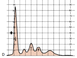 <p>Determine the condition of the patient given the serum electrophoresis graph</p><img src="https://knowt-user-attachments.s3.amazonaws.com/f718dbd4-a821-4dba-8409-f0ad5a9abb30.png" alt="knowt flashcard image"><p>A. α1 –antitrypsin deficiency</p><p>B. Nephrotic Syndrome</p><p>C. Inflammation</p><p>D. Liver Cirrhosis</p><p>E. NOTA</p>
