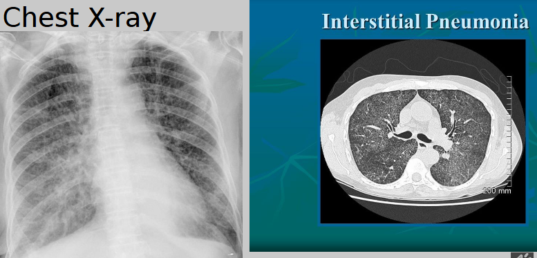 <p>mesh-like shadows resulting from linear or reticular opacities — untreated can lead to <strong>“honeycomb lung”</strong> or cystic spaces as demonstrated by CT</p>