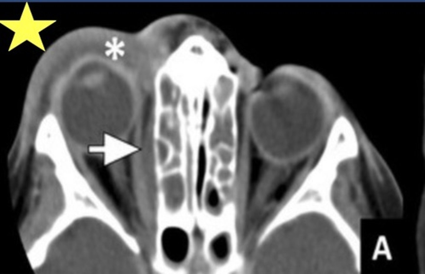 <p>Identify the radiographic abnormality. (Note the asymmetry between anterior positioning of the eyes)</p>