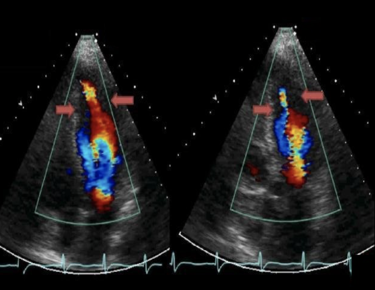 <p>The image displays a focal wall structure and motion abnormality caused by? </p>