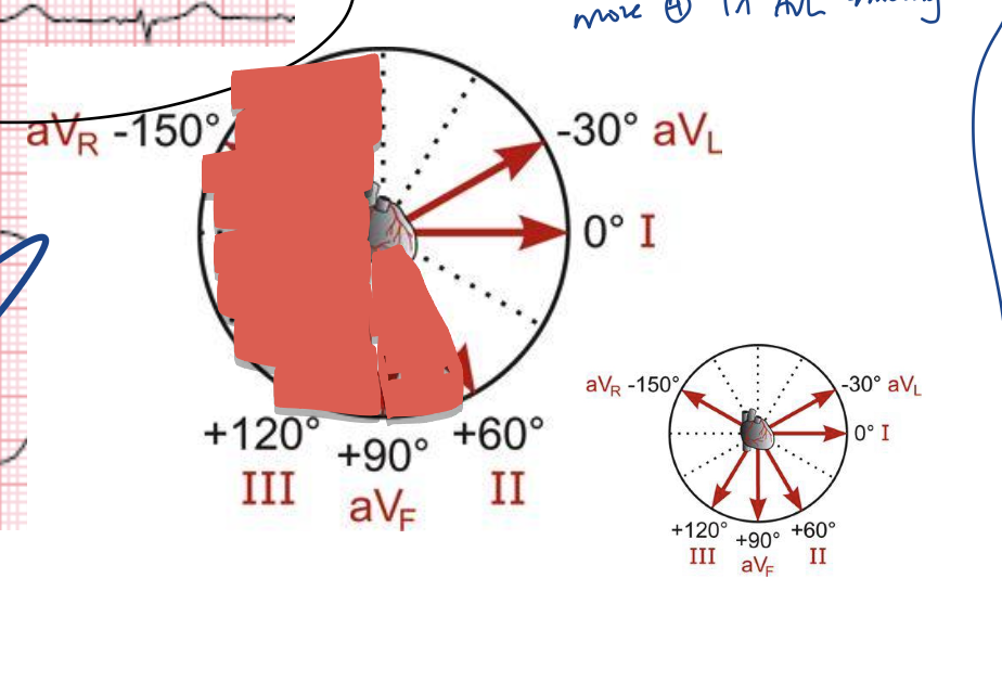<ul><li><p>find the most biphasic tracing → aVF</p></li><li><p>what is perpendicular to aVF? → lead I</p></li><li><p>is lead I’s tracing + and -? → +</p></li><li><p>is lead II’s tracing more + or -? → +</p></li><li><p>what is perpendicular to lead II? → aVL</p></li><li><p>is aVL’s tracing more + or - ? → more +</p></li><li><p>is the mean electrical axis closer to lead II or avL? → probably closer to avL because it has taller positive deflections</p></li><li><p>is there an axis devation? → could be LAD (left axis deviation)</p></li></ul><p></p>