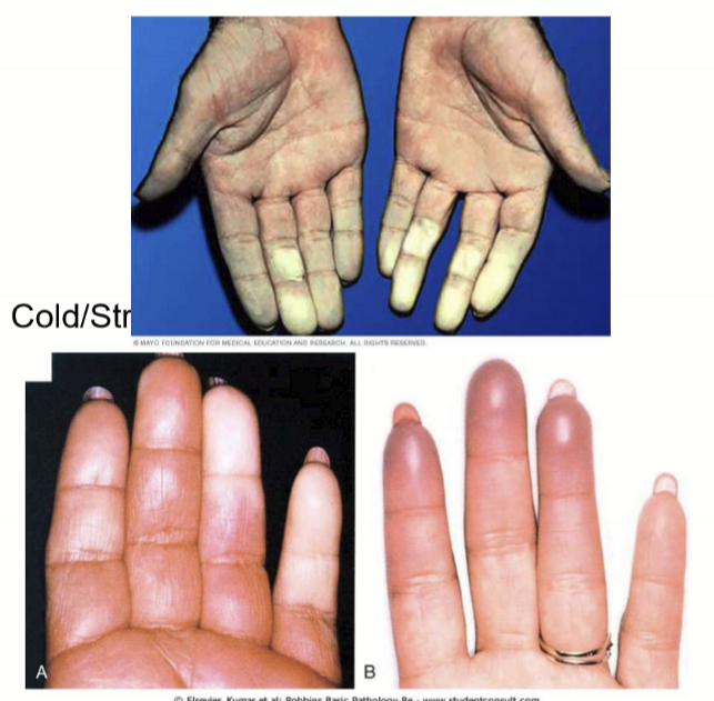 <p>Abnormal vasospasm triggered by cold or emotion affecting fingers and toes.</p>