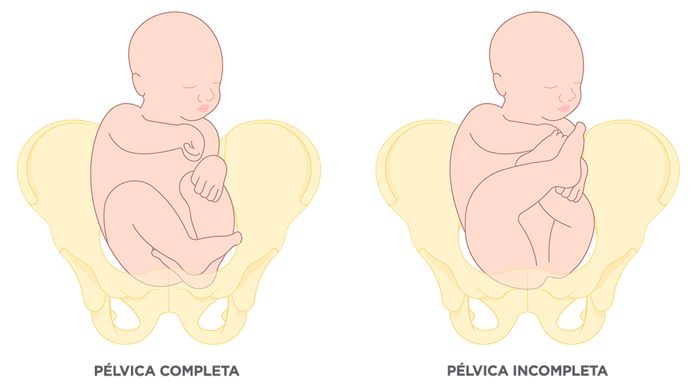 <p>completa: pelve e pés se apresentando (pelve podálica)</p><p>incompleta: pernas fletidas</p>
