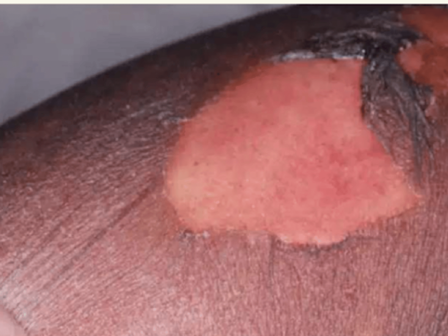 <p>¿lesión?</p><p>¿primaria o secundaria?</p>