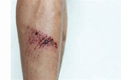 <p>What is a wound caused by rubbing the skin or mucous membrane?</p>