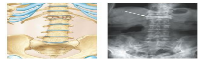 <p>Fracture in which the bone is crushed under the weight it is meant to support; common in the elderly and those with reduced bone mass</p><p>(An illustration and an X ray of a compression fracture in the spine)</p>