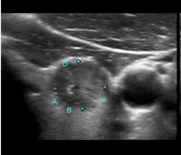 <p>What type of thyroid nodule is this - most common type of thyroid cancer (80%) and metastasizes via the lymphatics?</p>