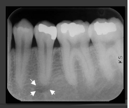 <p>Presents as small ovoid radiolucent areas near the apical region of the premolars in the mandible.</p>