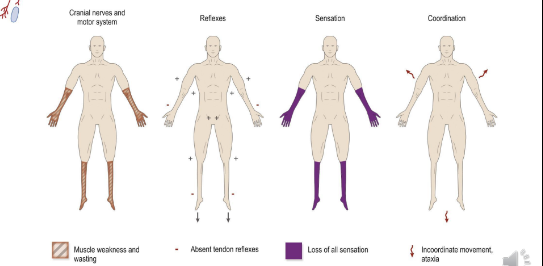 <ul><li><p>Various patterns exist, but in general the longest nerves are damaged first creating a ‘glove and stocking’ sensory loss pattern (distal weakness)</p></li><li><p>Reflexes diminished / absent</p></li><li><p>Chronically, the condition can cause muscle wasting, and sometimes fasciculations</p></li></ul><p></p>