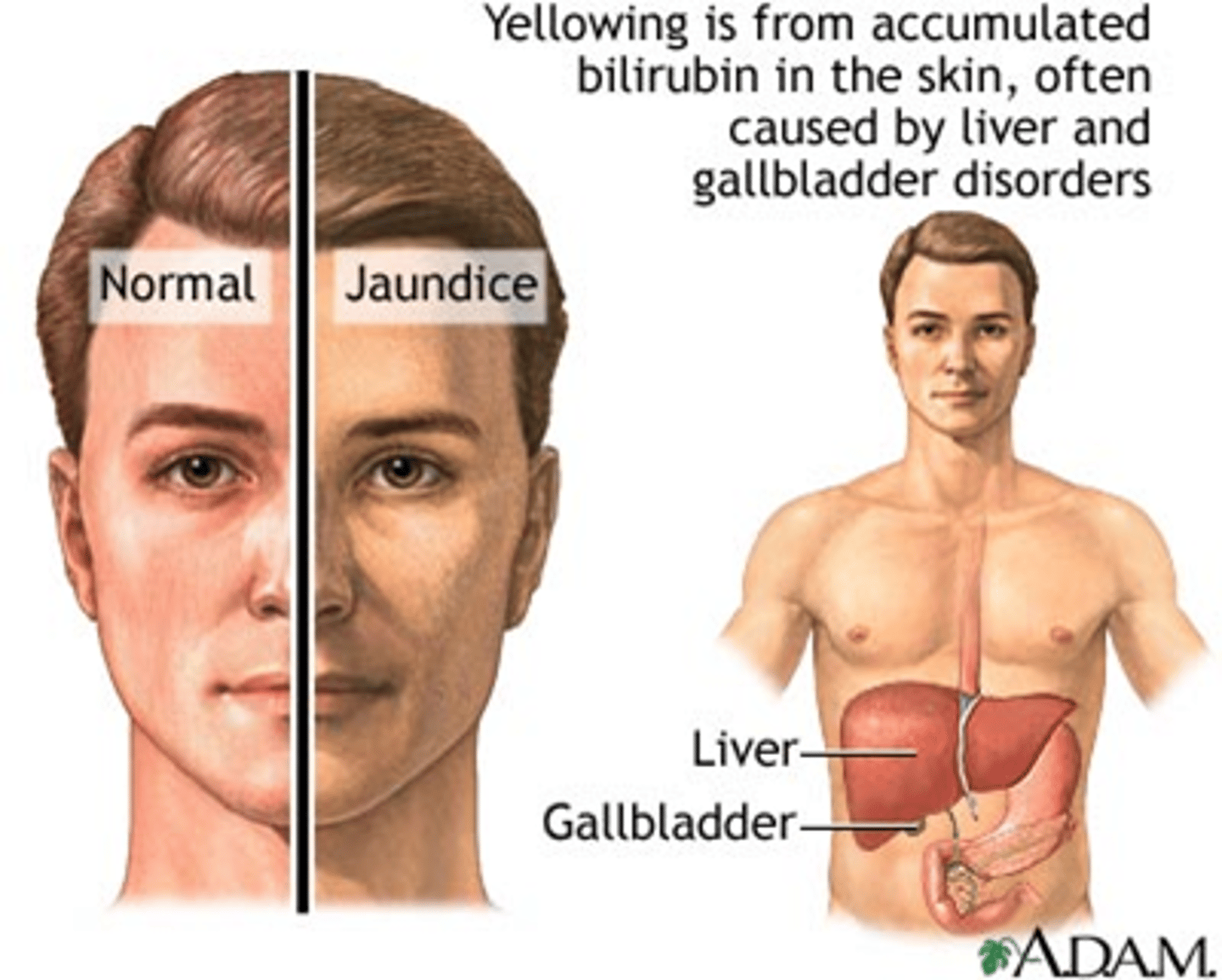 <p>Yellowish discoloration of skin and eyes due to increased circulation of bilirubin in peripheral tissues</p><p>-> Due to liver not processing bilirubin or bile ducts blocked</p>