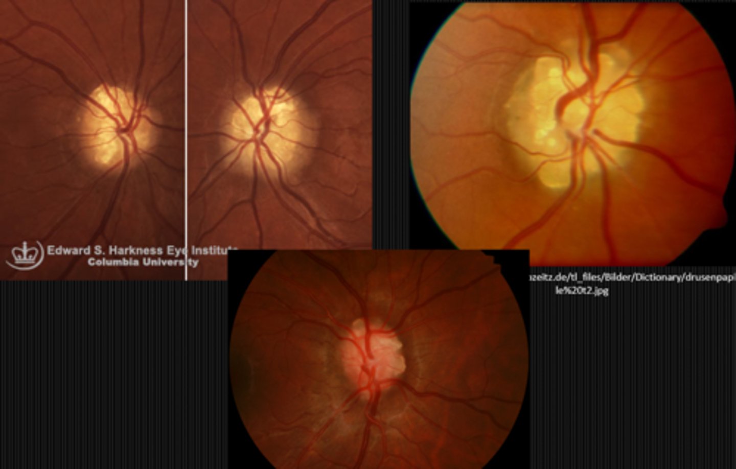 <p>drusen of the ONH</p>