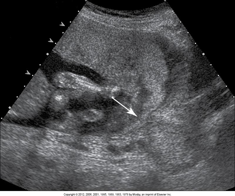 <p>transabdominal image of __ </p>