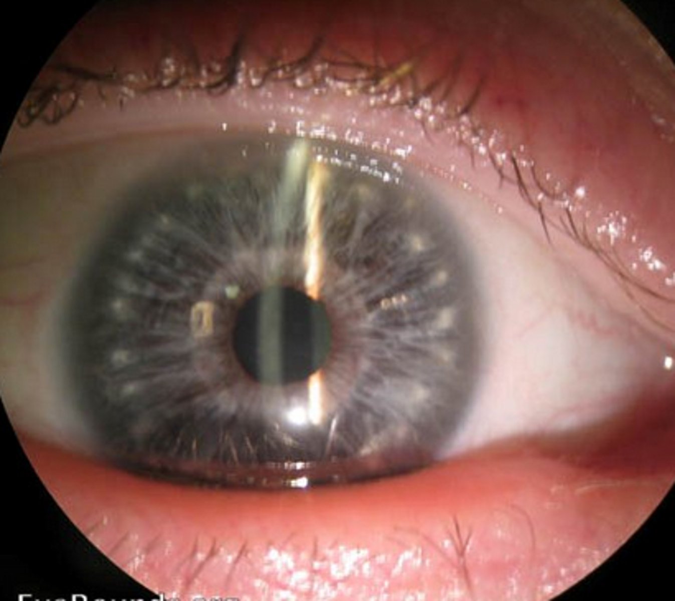 <p>down Syndrome</p>