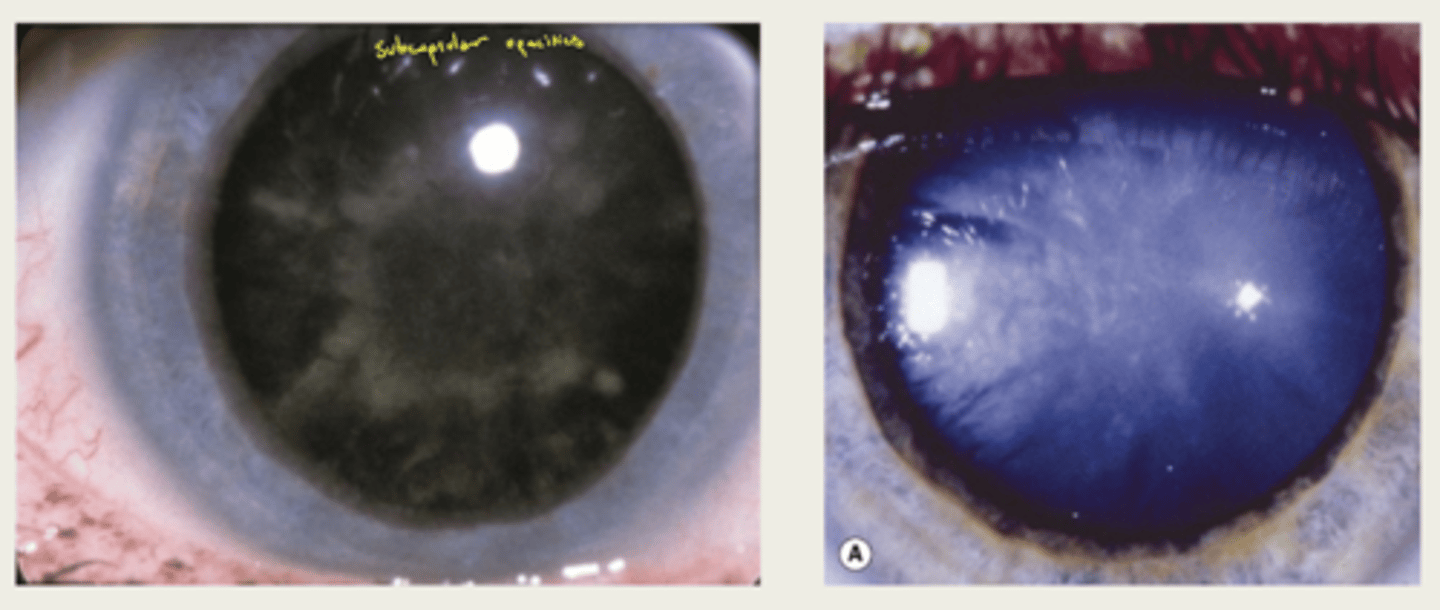 <p>1. grey-white branching opacities in snowflake appearance</p><p>2. eventually entire lens will turn white</p>