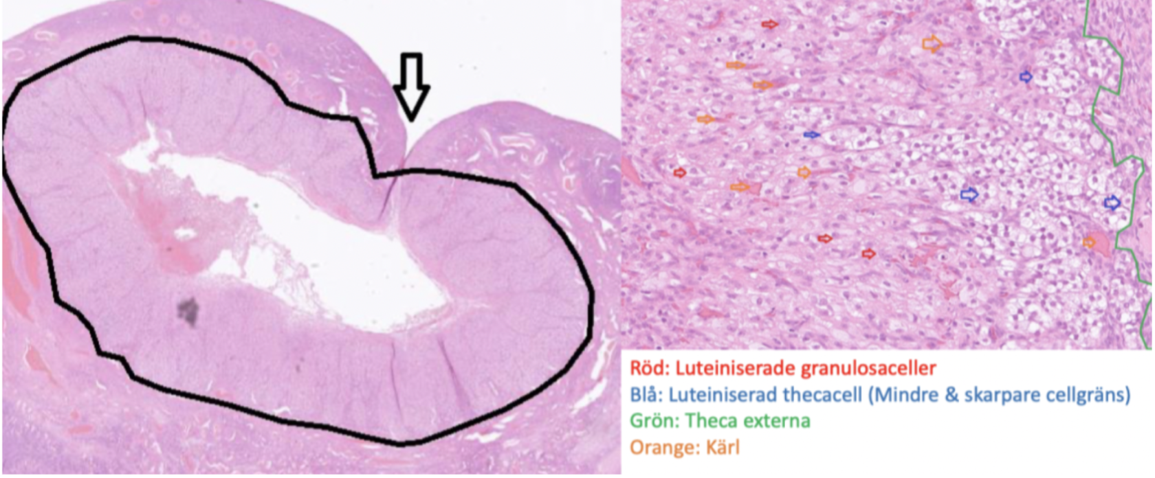 <p>Hormonellt aktiv rest efter ovulation. Här är de interna tekacellera och granulocyterna luteiniserade och producerar progesteron.  </p>