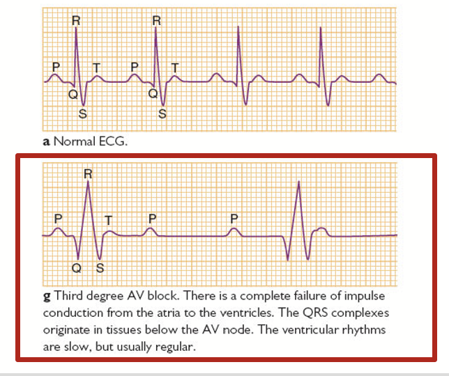 <p>A condition where the signals do not go from the atria to the ventricles. No connection between the parts of the heart, no electrical conduction.</p><p>In this case, an animal would not be able to survive this type of heart dysfunction. In humans, technology has reached a point where we can use pacemakers to synchronize the electrical conduction in the heart.</p><p>Ventricular rhythms are slow, but usually regular.</p>