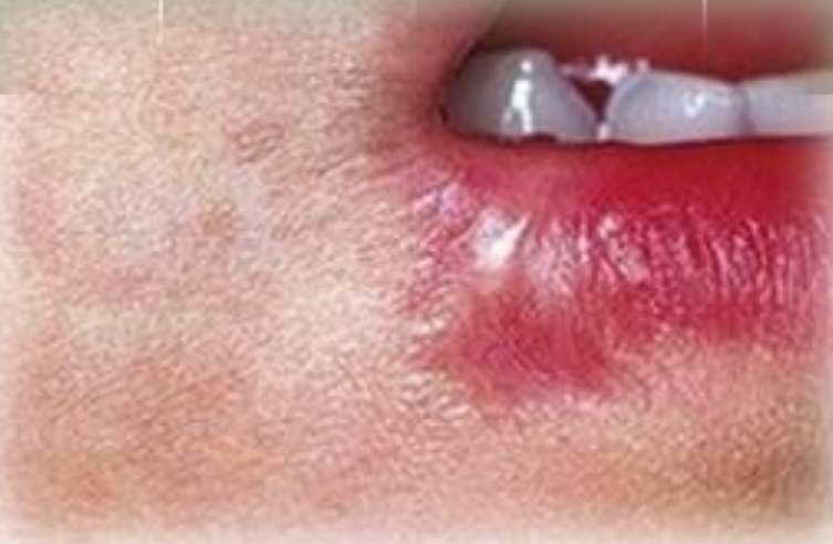 <p>White or pale pink line, or smooth irregular patch with crosshatch or starburst pattern</p><p class="has-focus">Asymptomatic</p><p class="has-focus">First and second decades</p><p class="has-focus">No gender bias</p><p class="has-focus"><strong>Found on:</strong></p><p class="has-focus">Any site; common on labial mucosa, lip vermillion, tongue</p><p class="has-focus"></p><p class="has-focus is-empty">Ask: history of trauma or surgery?</p>