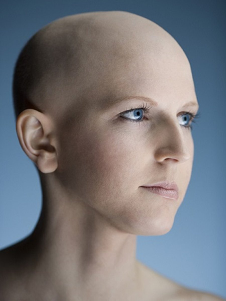 <p>the partial or complete absence of hair from areas of the body where it normally grows; baldness</p>