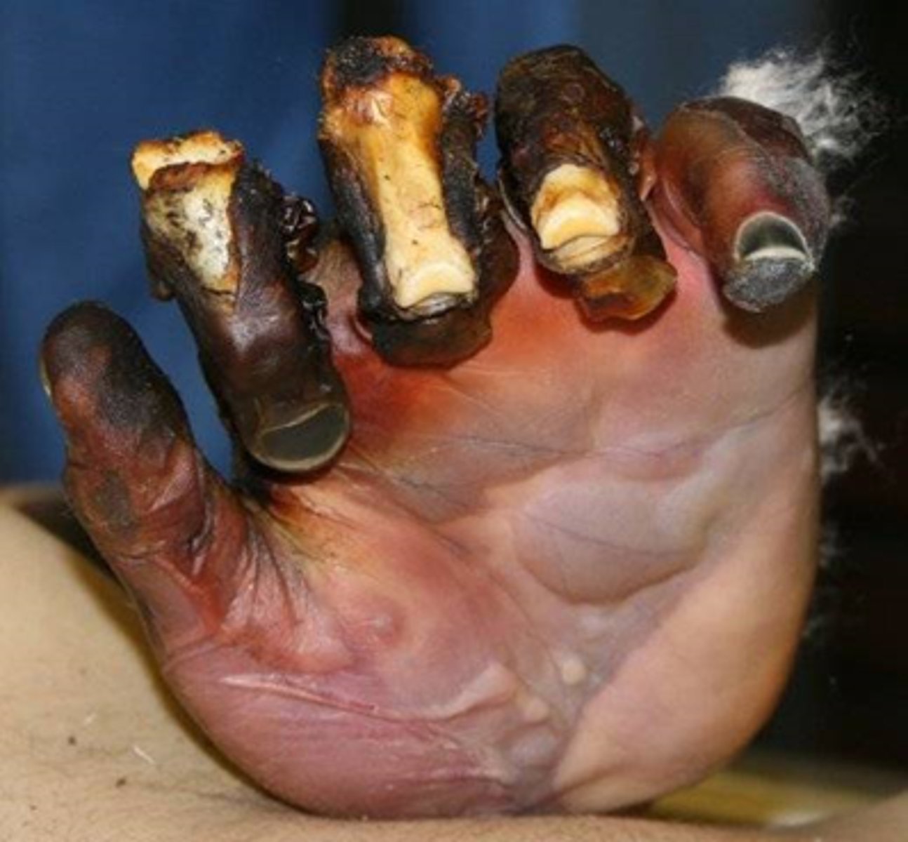 <p>-Damage extends into muscle, tendon, bone</p><p>-Black</p><p>-Severe edema</p><p>-NO blisters</p><p>-NO pain</p><p>-Eschar</p><p>-Healing time weeks to months, if at all</p>