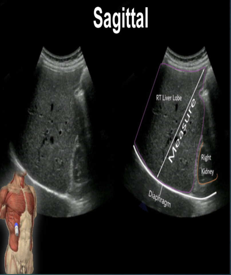 <p>&lt; 16 cm (13-15 cm) in the midclavicular line </p>