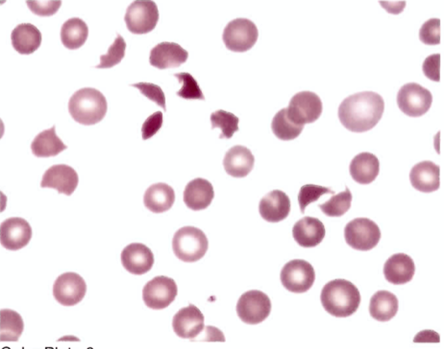 <p>D. Idiopathic thrombocytopenic purpura</p><p>(ITP)$</p>