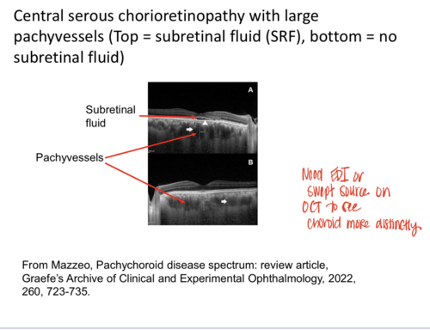 <p>Central Serous Chorioretinopathy with Large Pachyvessels (Pic)</p>