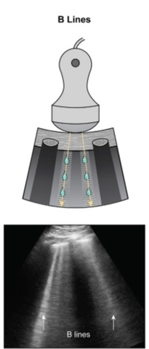 <p>Vertical</p><p>Seen in pathological lungs</p>
