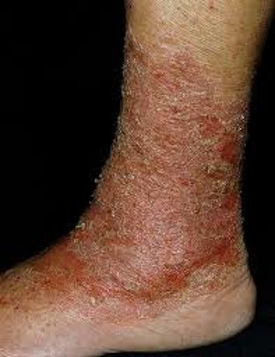 <p>Inflammatory</p><p>Hyperpigmentation</p><p>ankles; lower legs</p>