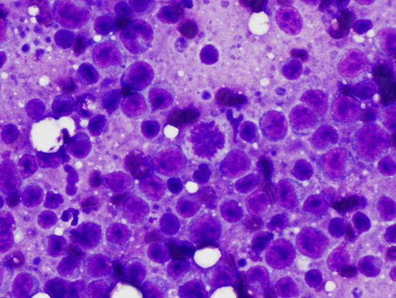 <p>A 7-year old female Lhasa Apso presents to you for lethargy and inappetence. On your exam, you detect mandibular lymphadenopathy and perform a fine needle aspirate. You see the aspirate depicted here. Which of these treatments would be given to this patient as part of a first line therapy?</p><p></p><p>Prednisone</p><p>Doxycycline</p><p>Carboplatin</p><p>Milbemycin</p><p>Itraconazole</p>