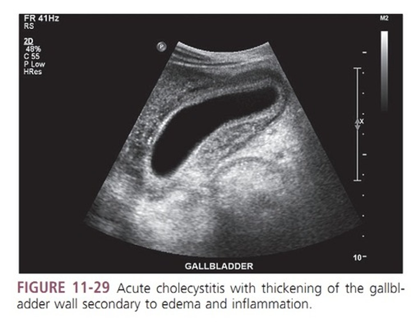 <p>- POSITIVE murphy sign</p><p>- Gb wall extreme thickening > 4-5 mm</p><p>-pericholecystic fluid</p><p>- sludge</p>
